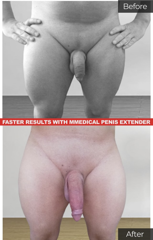 Phallosan forte penis extender